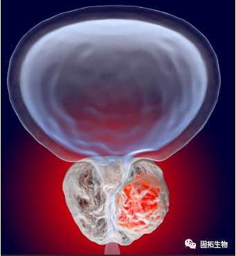 前列腺癌新藥！基肽酶抑制劑talabostat聯(lián)合Keytruda在腺癌表型晚期難治性mCRPC療效令人鼓舞!